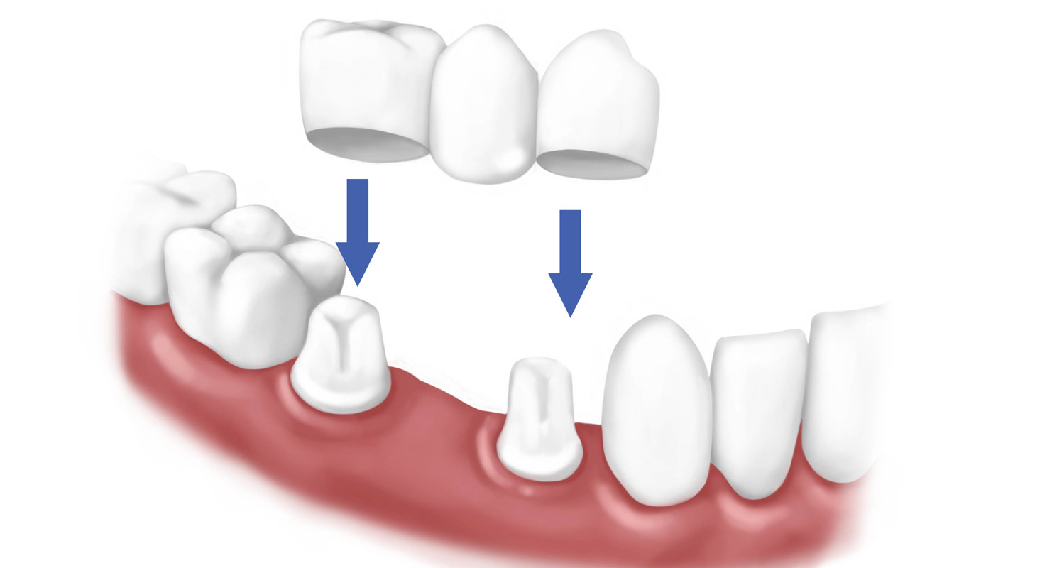 Ottawa-dentist-Jaleel-Nepean-Crowns-vs-Bridges