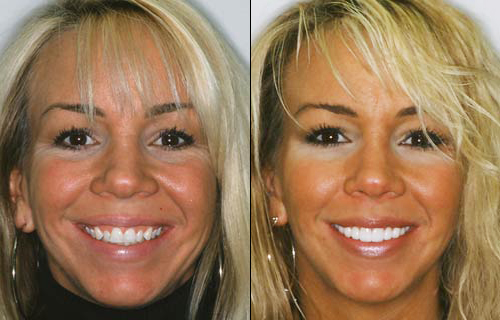 porcelain-veneers-before-and-after-headshot