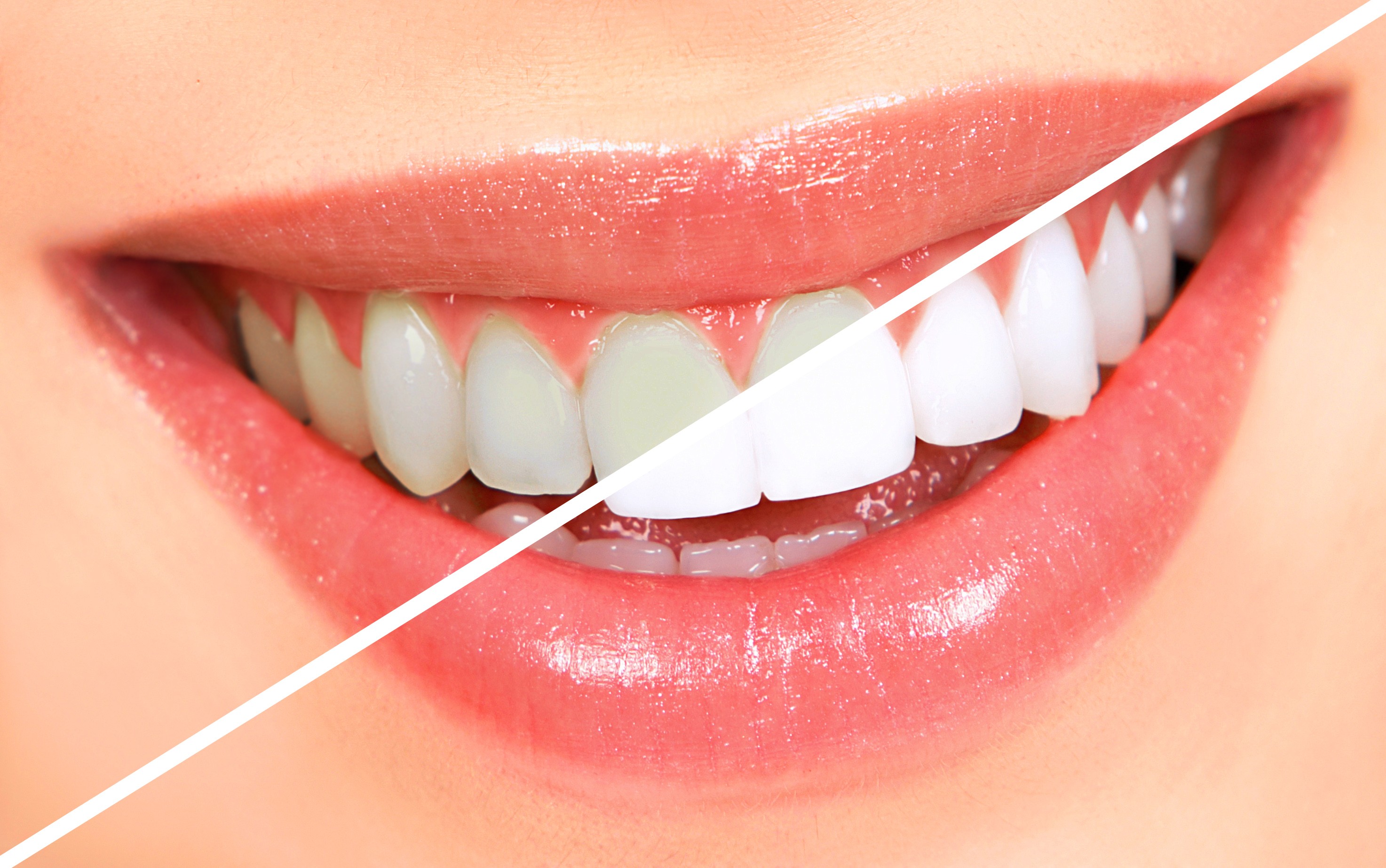 teeth-whitening3