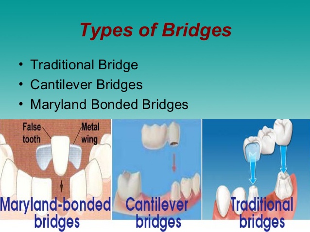 dental-bridges-in-greater-noida-5-638