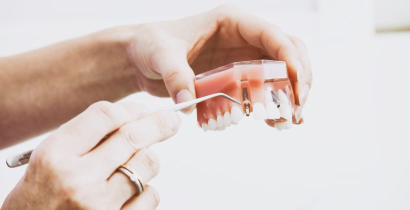 Dental Implant – How Do They Work?