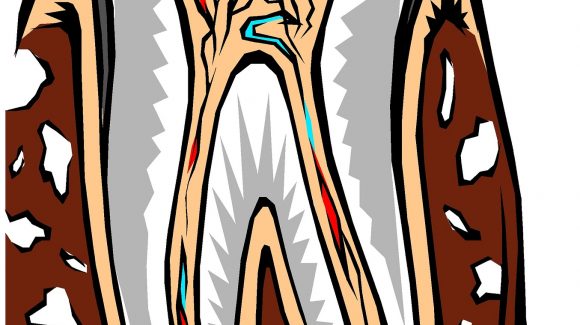 Root Canal – What’s True? Root Canal – What’s True?