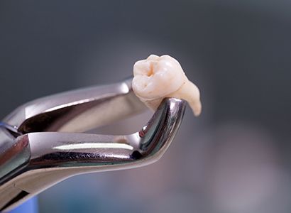 All about your tooth removal