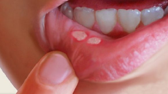 Mouth ulcers Mouth ulcers