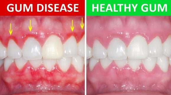 Periodontal Disease – The Silent Killer